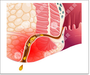 治疗痔疮费用_福州医博肛肠医院【推荐】 肛门损伤 肛瘘         对于