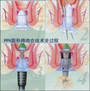 福州医博肛泰肛肠医院预约挂号