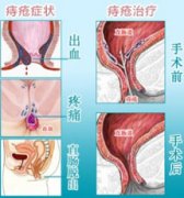 福州医博肛泰肛肠医院预约挂号