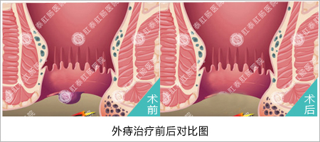 福州医博肛泰肛肠医院预约挂号