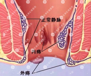 福州医博肛泰肛肠医院预约挂号