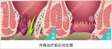 福州医博肛泰肛肠医院预约挂号