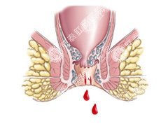 福州痔疮引起便血怎么办