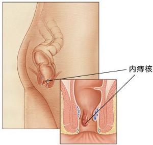 内痔疮都有什么症状？