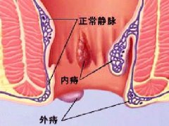 福州痔疮医院在那里