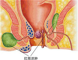 肛瘘前身——肛周脓肿的危害和预防措施